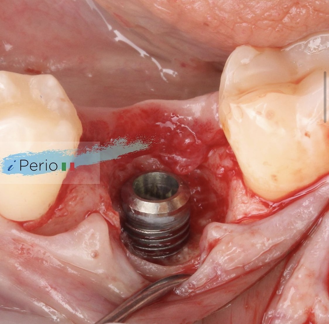 course courses periodontology perio surgery mucogingival rasperini