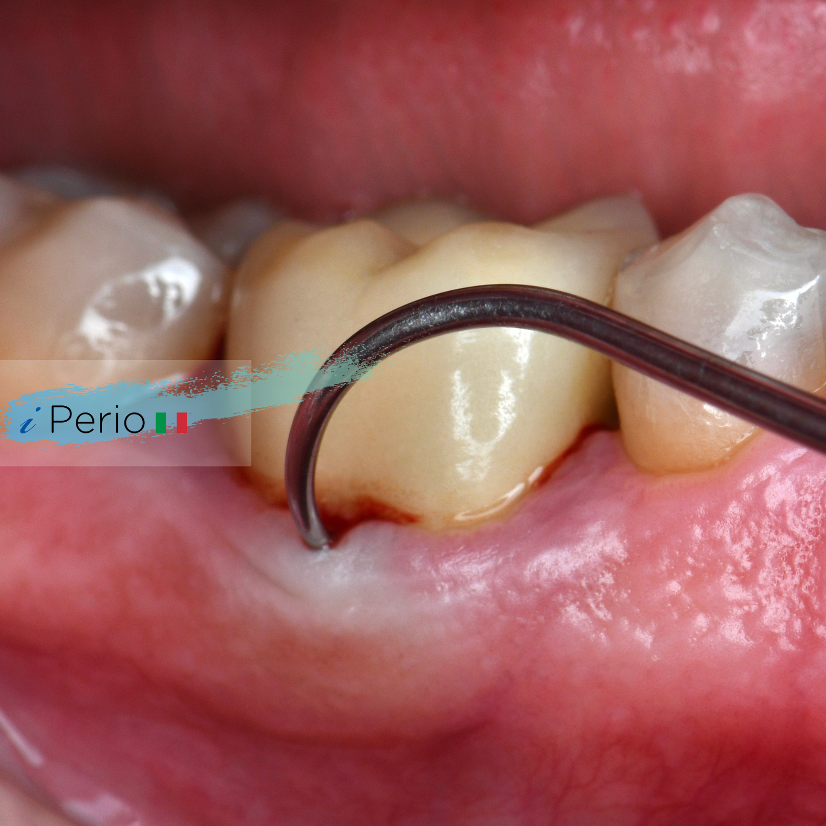 course courses periodontology perio surgery mucogingival rasperini