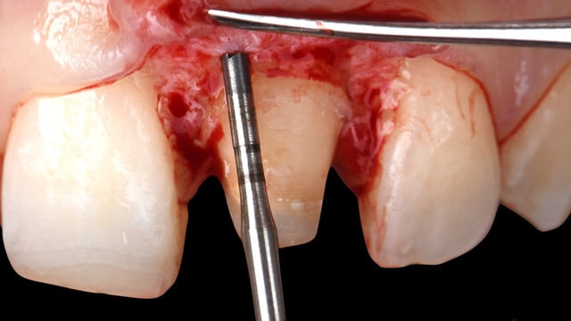 Periodontal surgical course rasperini education