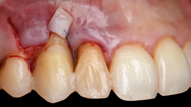 Perio surgical course rasperini education