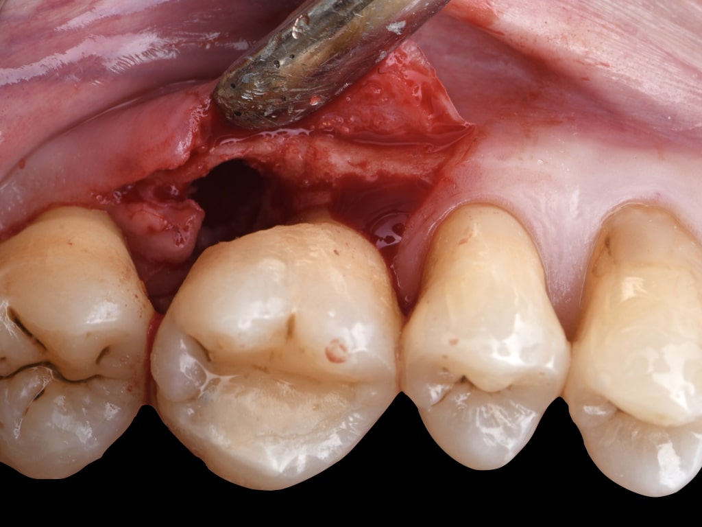 Perio surgical course rasperini